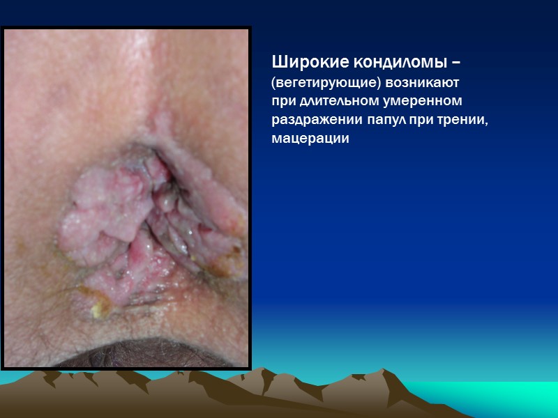 Широкие кондиломы –  (вегетирующие) возникают  при длительном умеренном раздражении папул при трении,